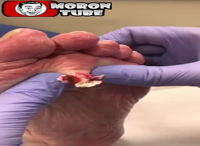 Video :That cyst needed to be emptied!